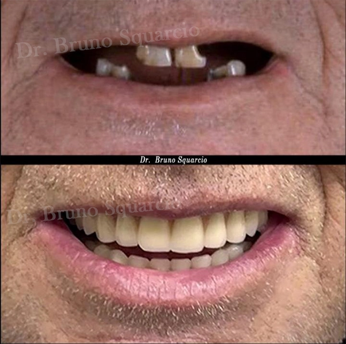 Dr-Bruno-Squarcio-Protocolo-implantes-dentes-fixos